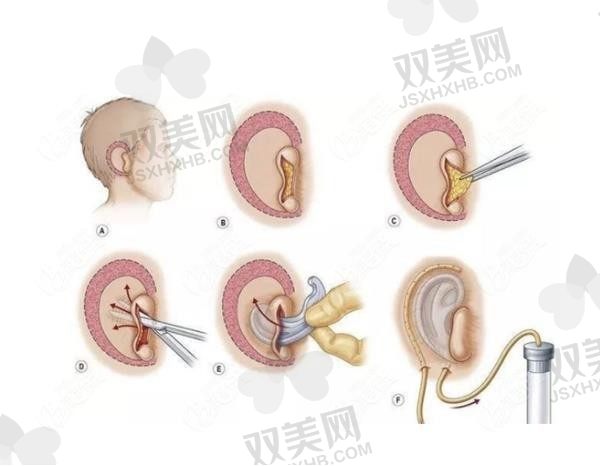 国内耳再造手术哪个医生做得好？求推荐
