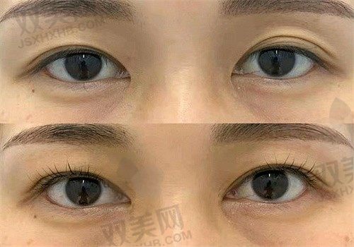 西安画美整形医院王逸涛双眼皮修复8000元起，可在线预约附案例分享