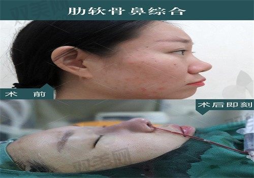 武汉美立方医疗美容医院胡江伟肋骨鼻综合35800元，打造自然精致鼻型