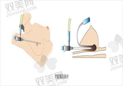 西安高一生美容医院张林宏假体隆胸4W起，内窥镜双平面隆胸效果好，可在线预约