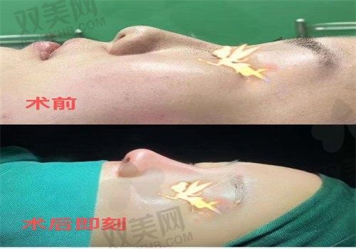 西安国际医学整形医院师俊莉鼻综合价格19800元起，附预约电话口碑