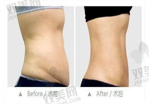 深圳八大处整形贾振华腹壁整形价3万起，可在线预约为您定制个性化方案