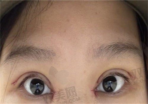 北京嘉禾整形医院李燕双眼皮3980元起，内附详细价格表，患者赞誉不断