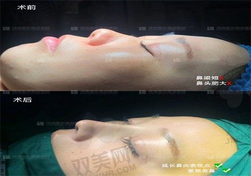河南整形美容医院胡志成鼻综合6900起，打造自然美鼻附咨询电话