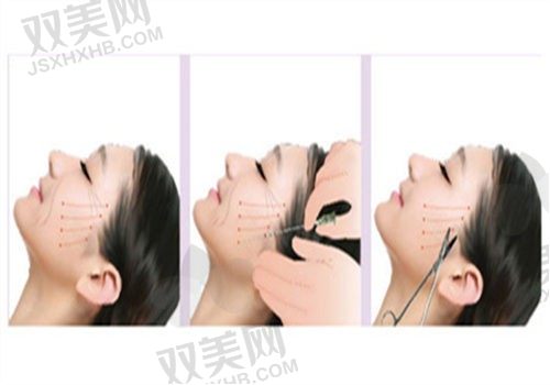 哈尔滨蜜柚医疗美容医院宋扬轮廓固定5万元细分项目介绍，打造精致立体轮廓