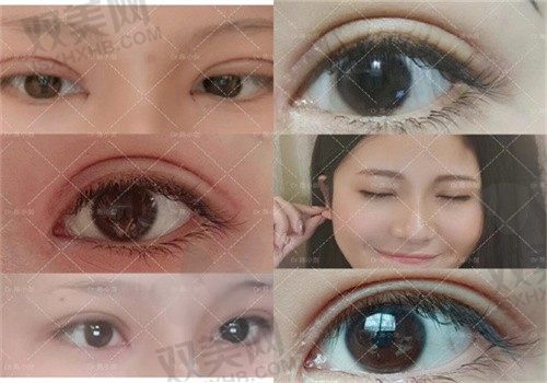 陈小剑上海华美整形高难度眼修复6800元起，知名眼修复专家可在线预约