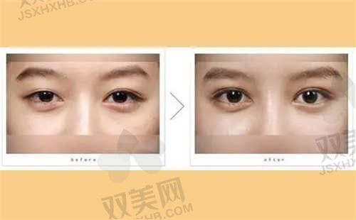 上海盈美整形医院美容眼整形价格6800元起，其他眼部整形价格也在这