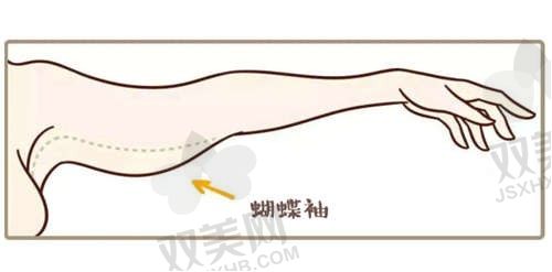 长沙艺脂医疗美容医院手臂吸脂价格1580元起，塑造纤细修长的手臂曲线