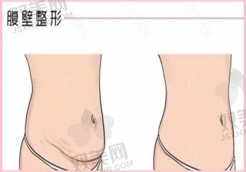 上海华美医疗美容李健腹部拉皮3.8万起，预约电话实例全都有！