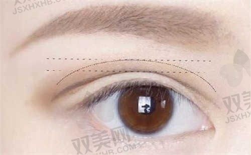 湖北武汉伽美医疗美容医院高计堂去眼袋7000元起，打造你的专属美丽