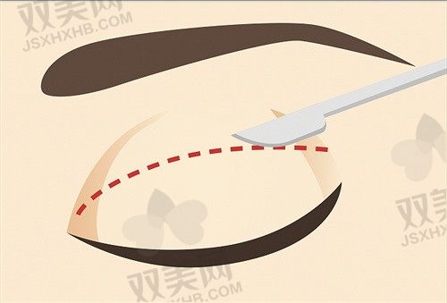 深圳艺星医疗美容医院双眼皮修复价格13800元起，眼部精雕！