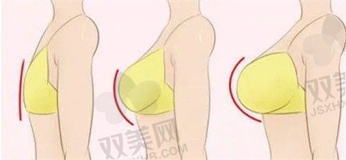  成都军大整形美容医院杨勇假体隆胸49800元起，技术精湛且口碑好