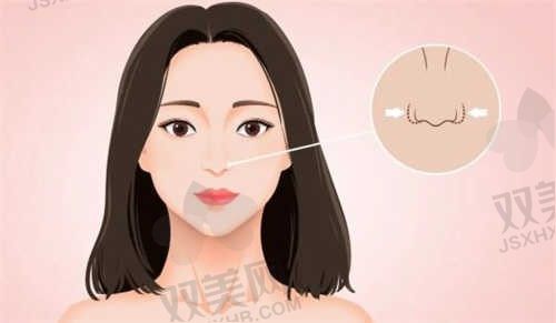 阜阳永功整形王永功肋骨鼻价格仅需3.8万元起，打造精致鼻型！