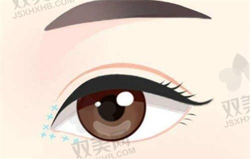 宁波尚丽整形医院汪栋梁双眼皮价格3000元起，个性化设计自然又美观
