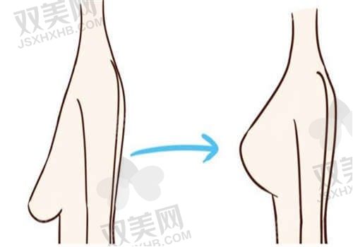 常州友谊整形医院顾晟乳房下垂矫正价格15000元起，重塑挺拔迷人胸型