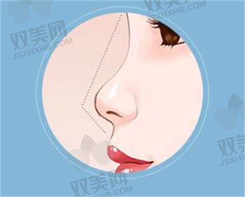 武汉五洲整形医院胡乔医生做鼻子价格32800元起,整形效果真不错