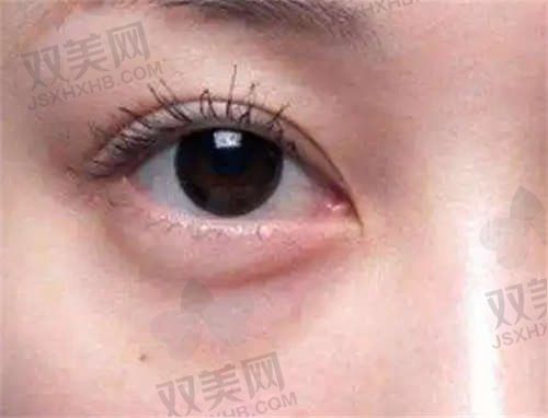 衡阳爱思特整形医院胡文好祛眼袋价格3800元起，手法老道效果自然