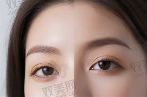 衡水唯美医疗美容医院陈海涛九度眼综合技术3803元起，术后自然恢复快