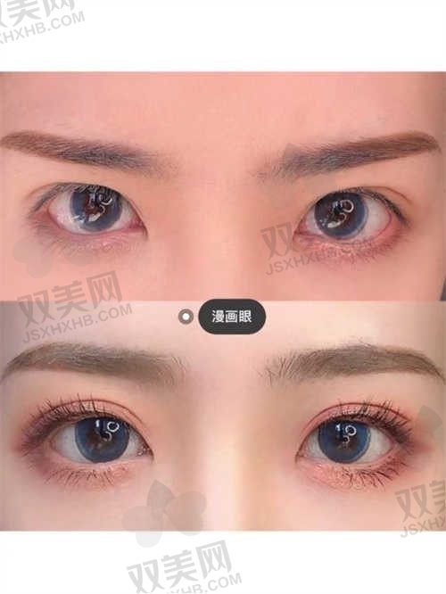 日照白求恩整形美容医院许建忠双眼皮修复1.8W+，可预约咨询