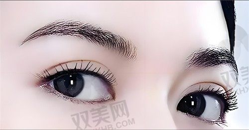 汕头市雅靓悦美荟双眼皮大综合12800元起，术后效果自然无痕