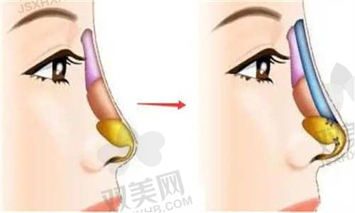 天津与时宜美医疗美容医院任召磊鼻综合价格22800元起，资深医师手法精准