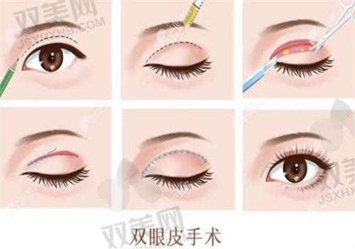 北京芙洛美整形医院黄昕昕眼修复19800起，打造眼周年轻态！