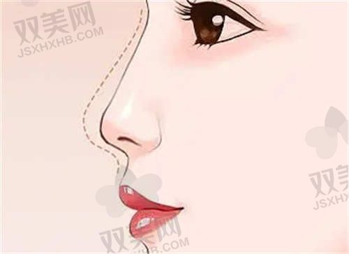 在杭州清锴医疗美容医院做的隆鼻感受：选十余年鼻经验的李保锴医生就对了，效果绝对惊艳