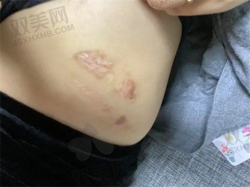 南昌祛疤痕较好的医院是哪个？南昌肤康皮肤病医院祛疤好，仅需2369元起