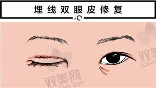 北京丰联丽格医疗美容师丽丽修复双眼皮怎么样?双眼皮修复案例和价格分享