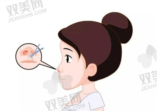 西安雁塔伊美尔隆鼻整形美容医院王清峰硅胶隆鼻15802 元起，鼻子小巧挺立效果还不错