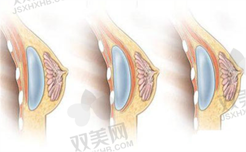 武汉仁爱时光医疗美容门诊部的丰胸优势.png