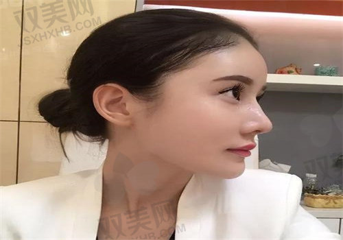 成都铜雀台周柯院长肋骨鼻手术优势有哪些？