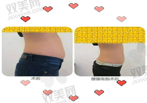 重庆铜雀台整形医院腰腹吸脂患者口碑：