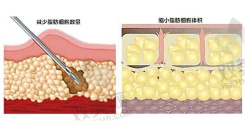 河南整形美容医院腹壁成型术价格表.jpg