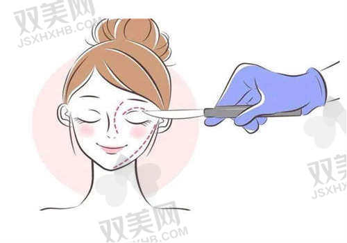 张莎莎医生双眼皮手术价格范围