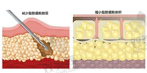 长沙亚韩自体脂肪全脸填充价格表
