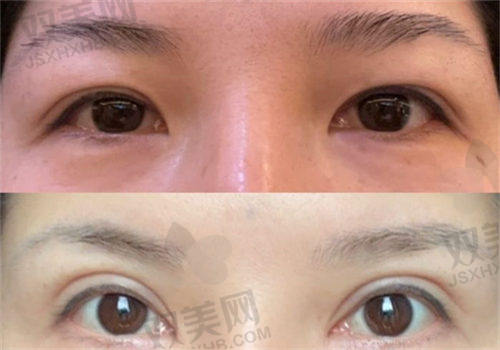 成都画美医疗美容医院黄元利眼综合患者评价