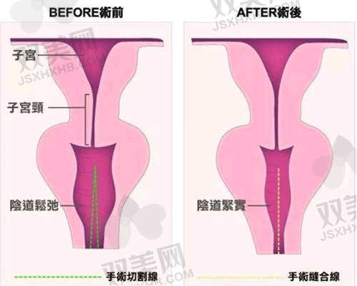 东莞环球美天元美整形医院私密整形技术优势