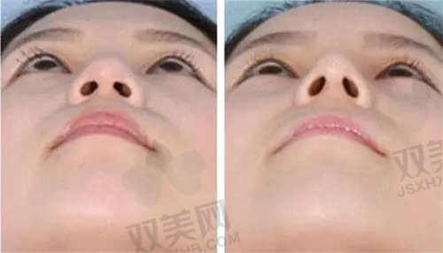 郴州唯美医疗美容隆鼻价格详情