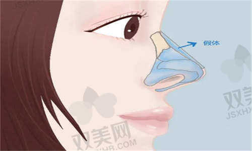 西安伊美尔医疗美容闫琪浩隆鼻价格