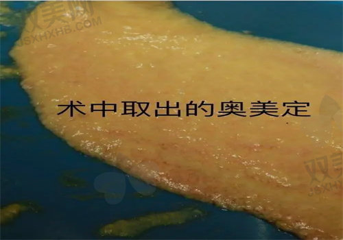 上海海华整形李营奥美定取出实例分享