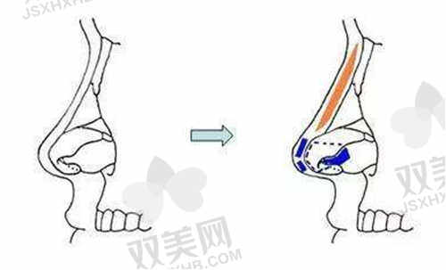 西安画美整形医院肋骨鼻综合项目详解