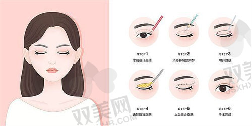汕头市雅靓悦美荟双眼皮大综合价格表