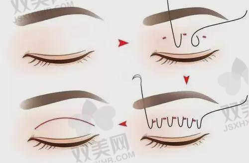 襄阳韩美医疗美容医院双眼皮手术价格