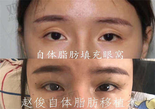 如何预约徐继强医生的眼睛整形手术