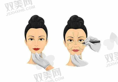 舟山艾美医疗整形医院韩风三点双眼皮患者评价