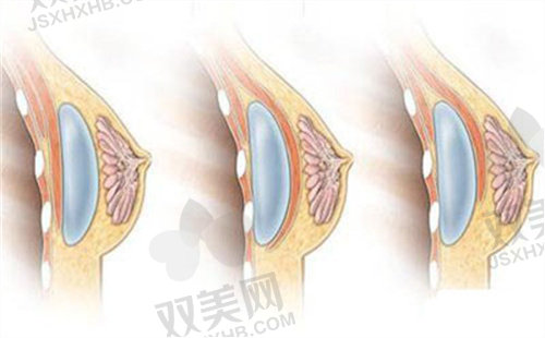上海艺星整形医院傲诺拉假体隆胸项目优势