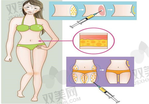 上海九 院曹卫刚做手臂吸脂手术口碑怎么样