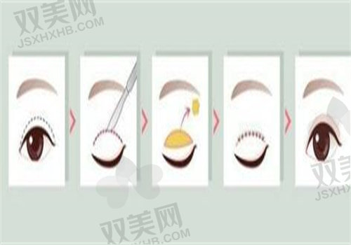 双眼皮术后修复要经历的五个阶段之消肿期