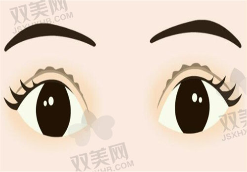 双眼皮术后修复要经历的五个阶段之成形期